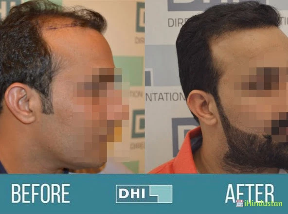DHI™ India - Best Hair Transplant Clinic in Delhi