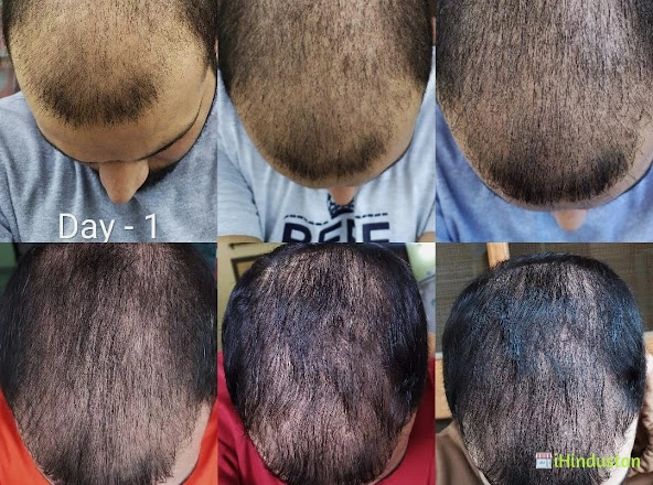 Neograft best hair transplant clinic chandigarh india - Photos Gallery in  Chandigarh, Haryana, India - iHindustan - Business, Shop, Classified Ads &  Events nearby you in India